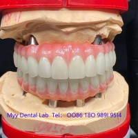 种植牙出口义齿加工厂3D打印种植牙加工厂